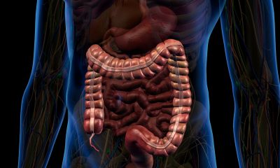 Crohn, nuova terapia rimborsabile: Aifa dà il via libera a mirikizumab